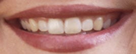 After Tooth whitening