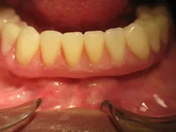 Fixed Detachable Dental Bridge