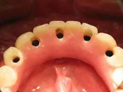 Fixed Detachable Dental Bridge