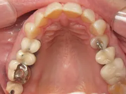 Full Mouth reconstruction After Surgery