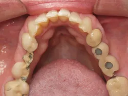 Full Mouth reconstruction Before Surgery