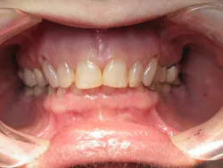 Full Mouth reconstruction Before Surgery