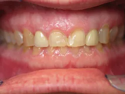 Full Mouth Reconstruction Before Surgery