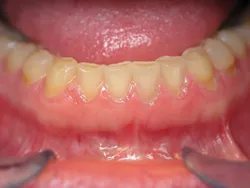 Full Mouth Reconstruction Before Surgery