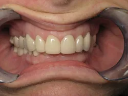 Full Mouth reconstruction Before Surgery