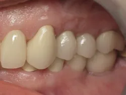 Full Mouth Reconstruction After Surgery