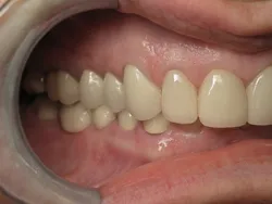 Full Mouth Reconstruction After Surgery