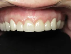 Full Mouth Reconstruction After Surgery