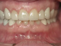Full Mouth Reconstruction After Surgery