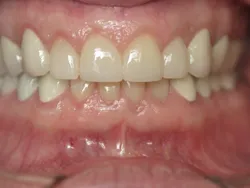 Full Mouth Reconstruction After Surgery