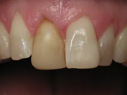 post operation crown and veneers