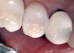 After tooth restoration