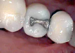 Before tooth restoration