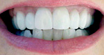 Porcelain Veneers: After Photo