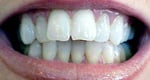 Porcelain Veneer before Photo Naperville IL
