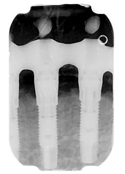 xray of detachable dental bridge