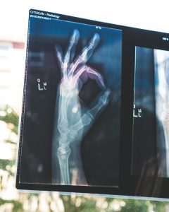 X-ray of human hand making 'OK' sign