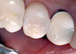 After tooth restoration